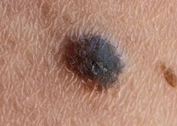 Personalized mRNA Therapy Marks a Turning Point in the Fight Against Skin Cancer