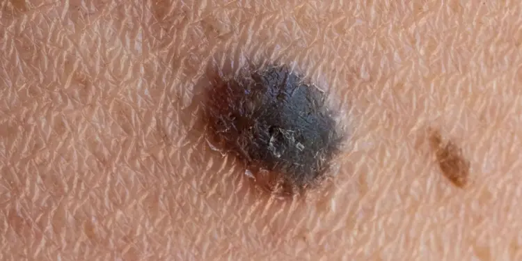 Personalized mRNA Therapy Marks a Turning Point in the Fight Against Skin Cancer